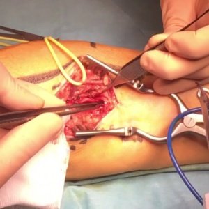 Vascular Surgery Instruments